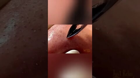 Remoção de Cravos e Espinhas - Remove Squeezing Blackheads and Pimples - Just Relax | Apenas Relaxe