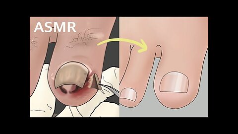 ASMR rot and ingrown toenail removal treatment animation