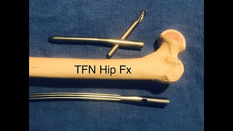 TFN. Trochanteric Fixation Nail. Intramedullary Nail.