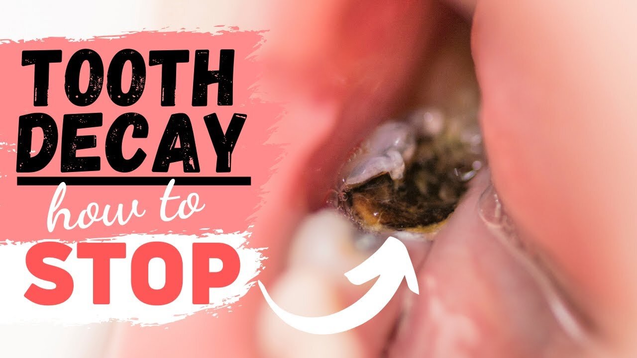 How To Stop Cavities and Treat Your Teeth and Gums