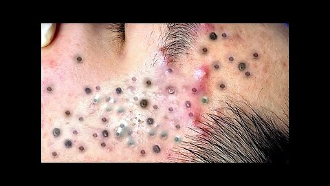 Satisfying blackhead removal, relaxing Pimple Popper 4453