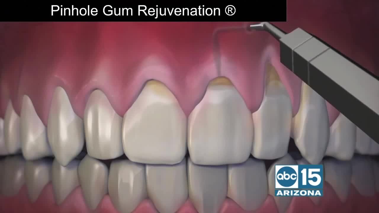 Dr. John Chao, dentist & inventor of "Pinhole Gum Rejuvenation®"