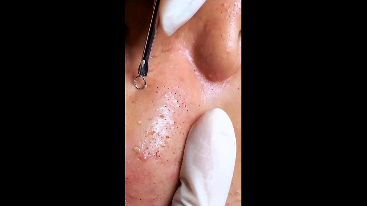 Blackheads episode 80