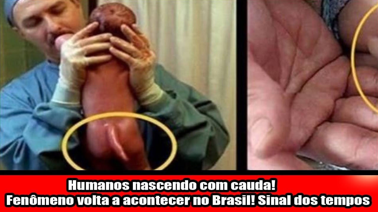 Humanos nascendo com cauda! Fenômeno volta a acontecer no Brasil! Sinal dos tempos