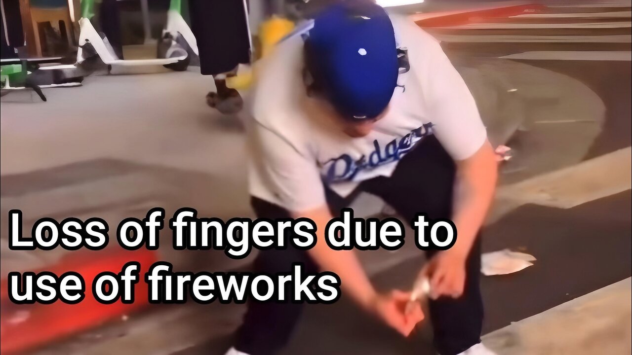 Loss of fingers due to use of fireworks