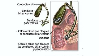 COLICO BILIAR BIODESCODIFICACION SOLUCION