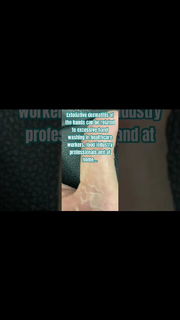 Terrible hand eczema #pov