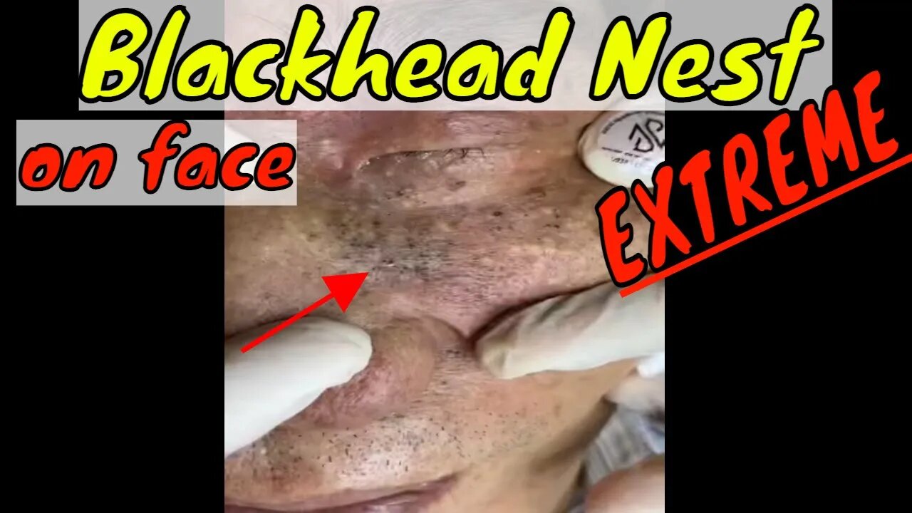 Extreme blackhead nest on face 😳 #blackheadremoval #blackhead #blackheads #fyp #fypage #fypviral