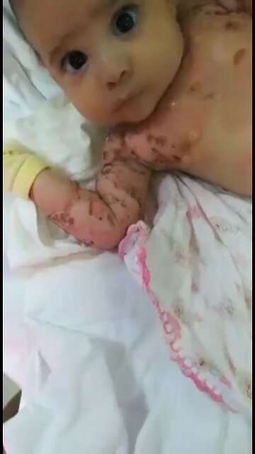 sick 1 month old baby born to HAXD GMO MUTANT MOM