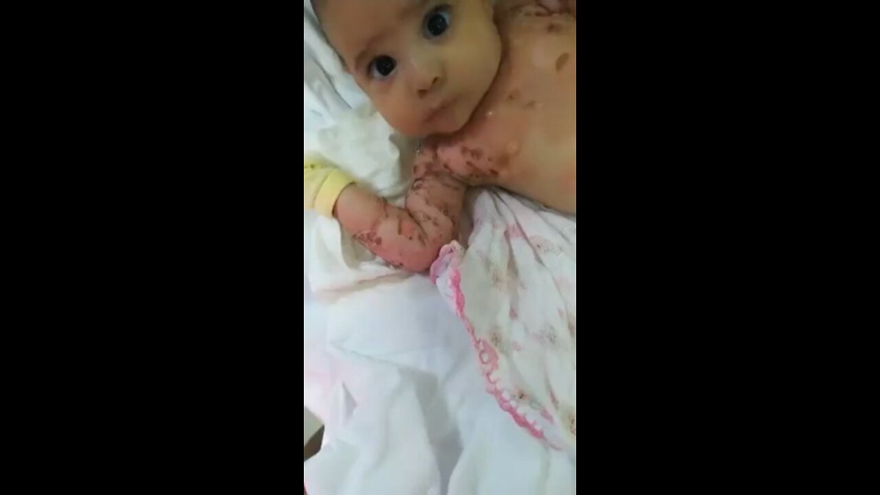 sick 1 month old baby born to HAXD GMO MUTANT MOM