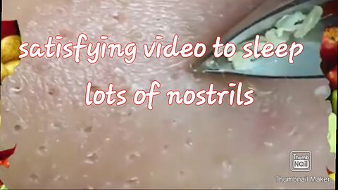 Blackhead removal satisfying video #4