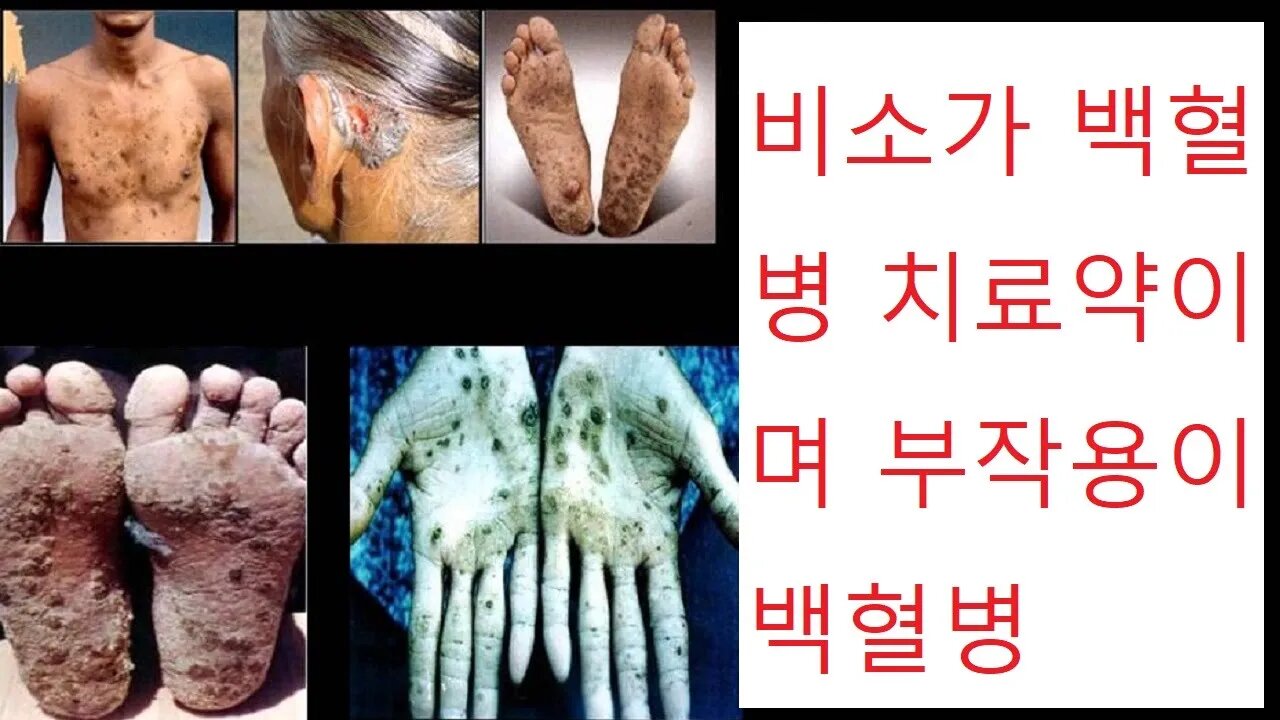 돌팔이 의학의 역사, 리디아 강, 네이트페더슨, 비소, 유산 상속을 위한 가루, 쥐약을 먹은, 매독구원자, 정말 비소를 백혈병 치료제로 쓰고 있음, 이상반응이 백혈구 증가증