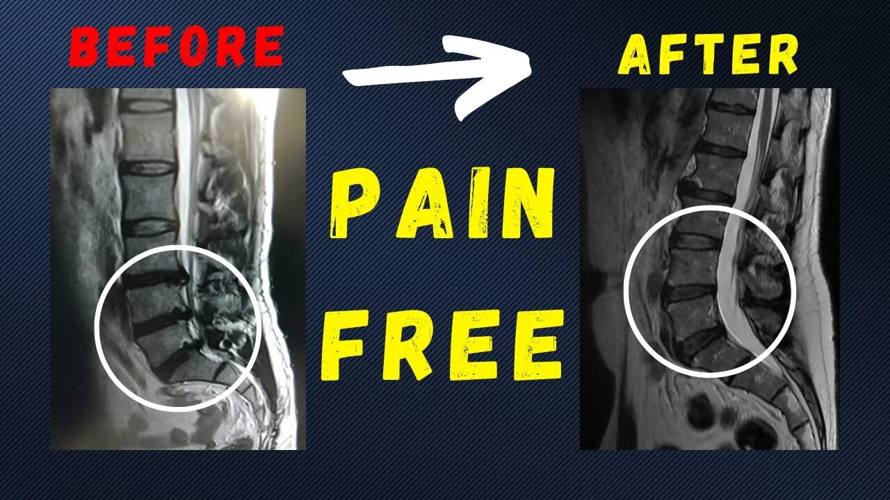 L4 L5 - L5 S1 disc herniation recovered pain free without surgery