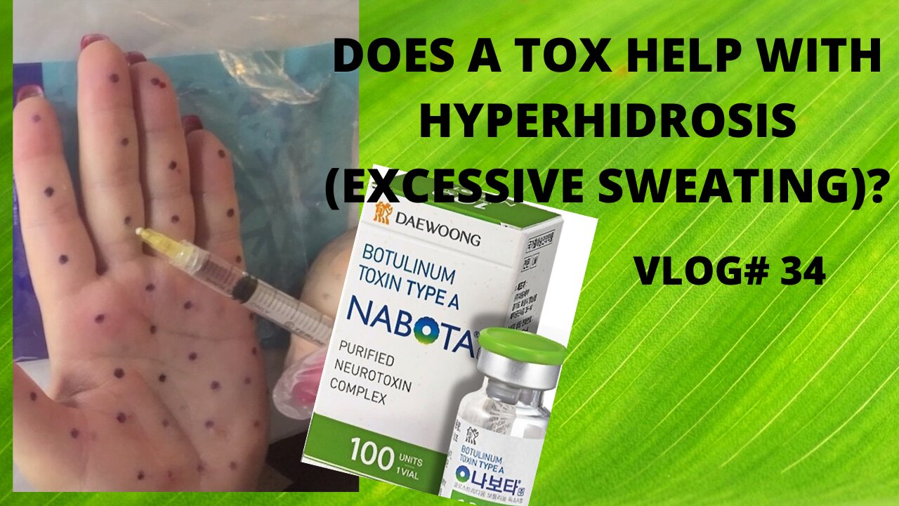 DIY HYPERHIDROSIS TREATMENT AT HOME! VLOG#34 #TOX #hyperhidrosis #nabota