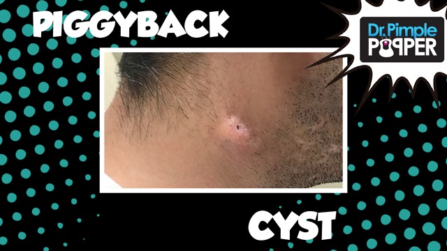 A Piggyback Cyst Excision on the Neck