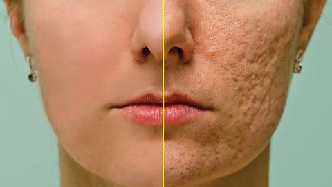 How To Remove Acne In Photoshop