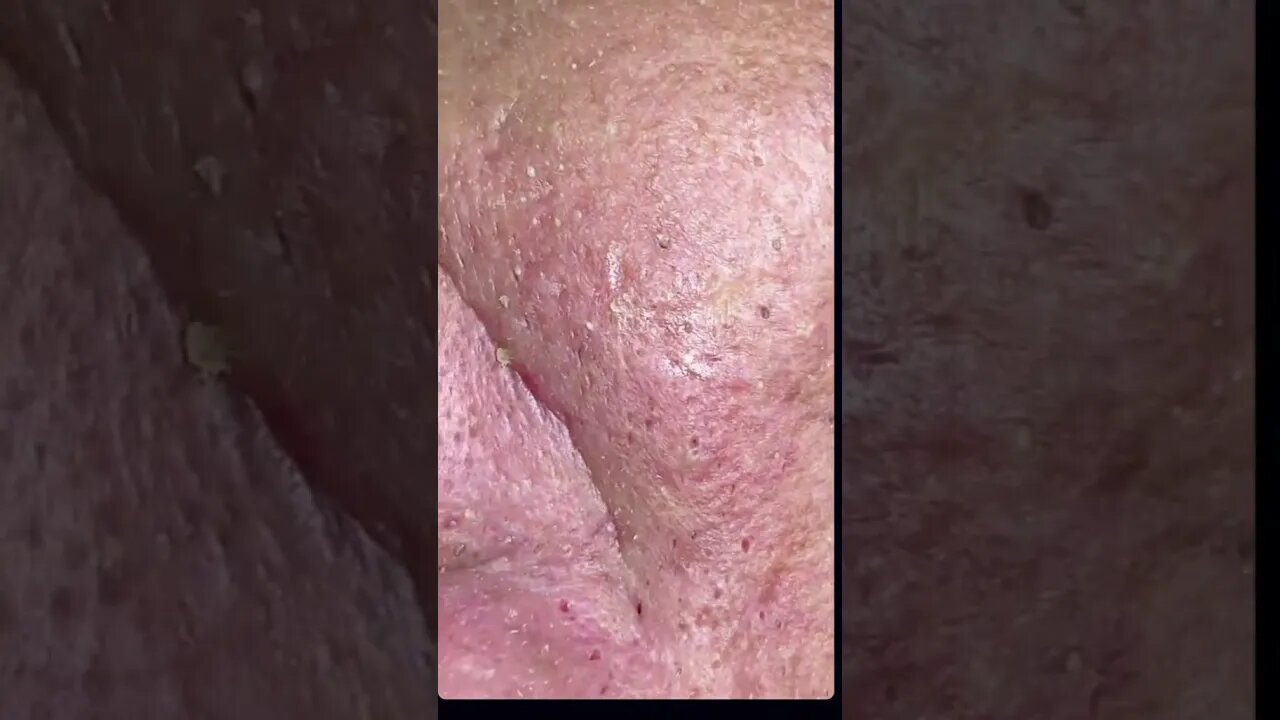 Remoção de Cravos e Espinhas - Remove Squeezing Blackheads and Pimples - Just Relax | Apenas Relaxe