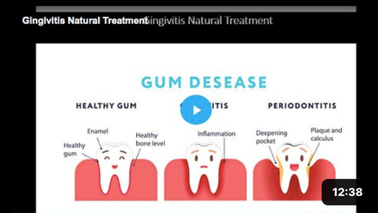 Learn about the natural treatment for gingivitis