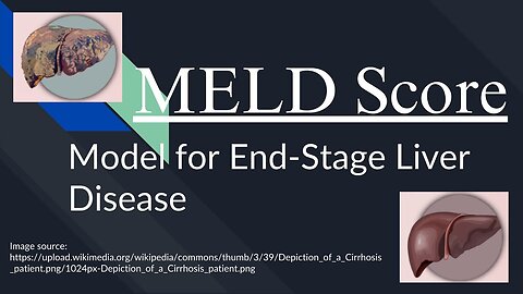 MELD Score: the Model for End-Stage Liver Disease | How to Calculate and Interpret MELD Score