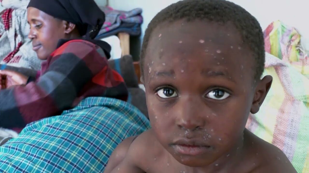 Fitch: Mpox adds to fiscal pressures in Sub-Saharan Africa | REUTERS