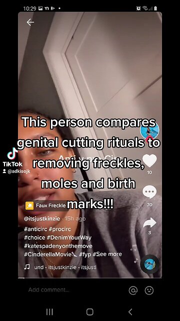 Just like removing moles and freckles