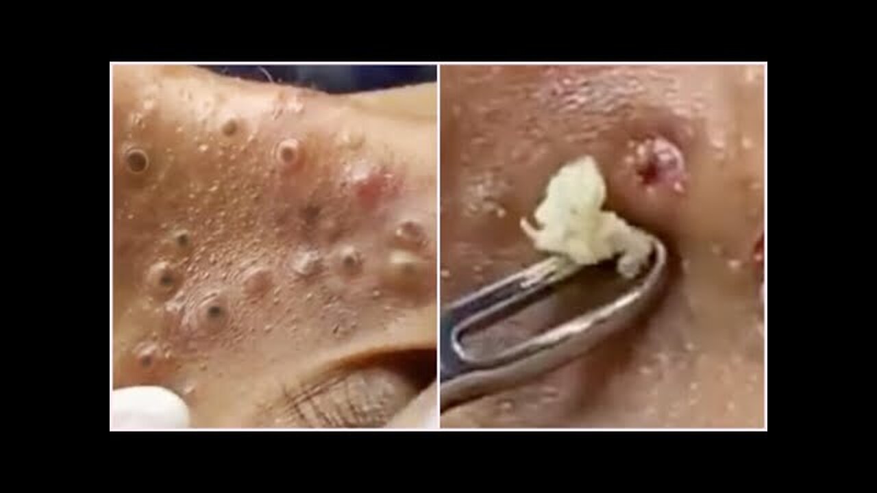 Dr Pimple Popper Cystic Acne Extraction