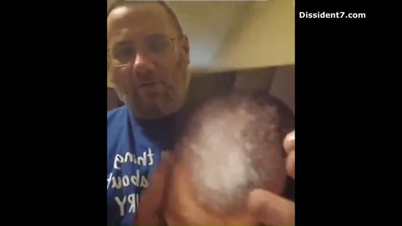 Vaccine Injured Man's Skin Starts Shedding!