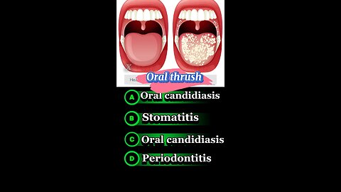 Oral thrush #mouthwash #oralinfection😬🪥🧑‍🎨 bacterial infection,viral infection