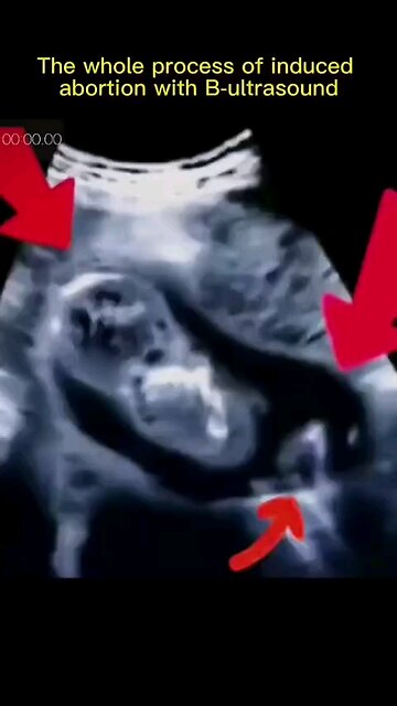 The Horror Of Late Term Abortion