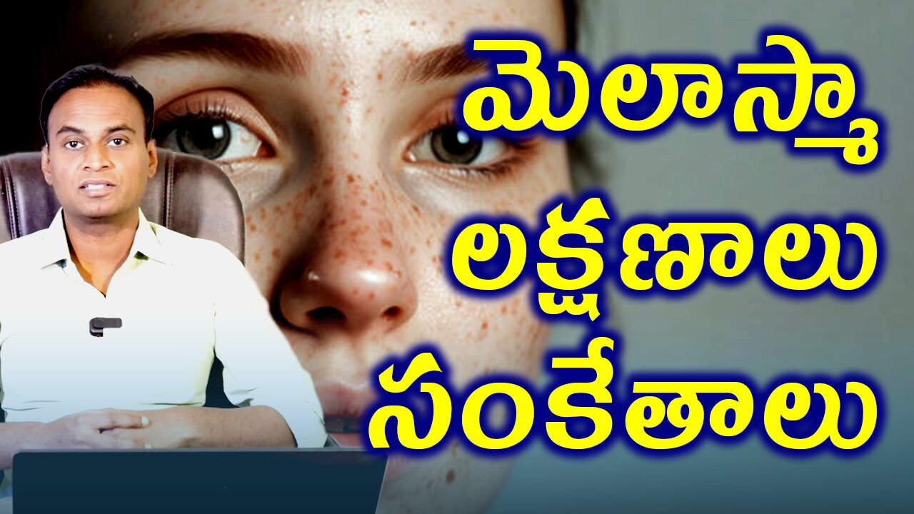 మెలాస్మా లక్షణాలు మరియు సంకేతాలు | మంగు మచ్చలు | Melasma Signs & Symptoms | Melasma Treatment & Cure