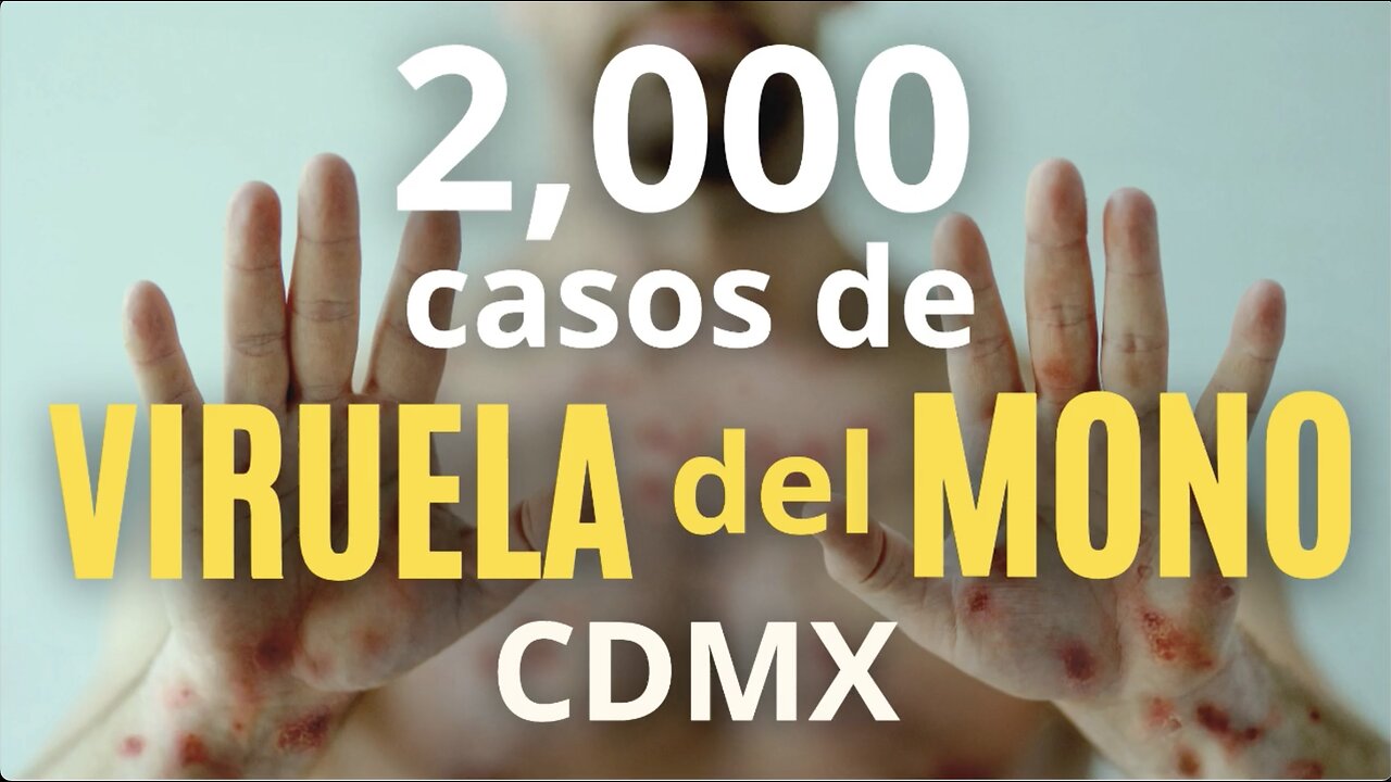 2,000 casos de "Viruela del mono" en la Ciudad de México