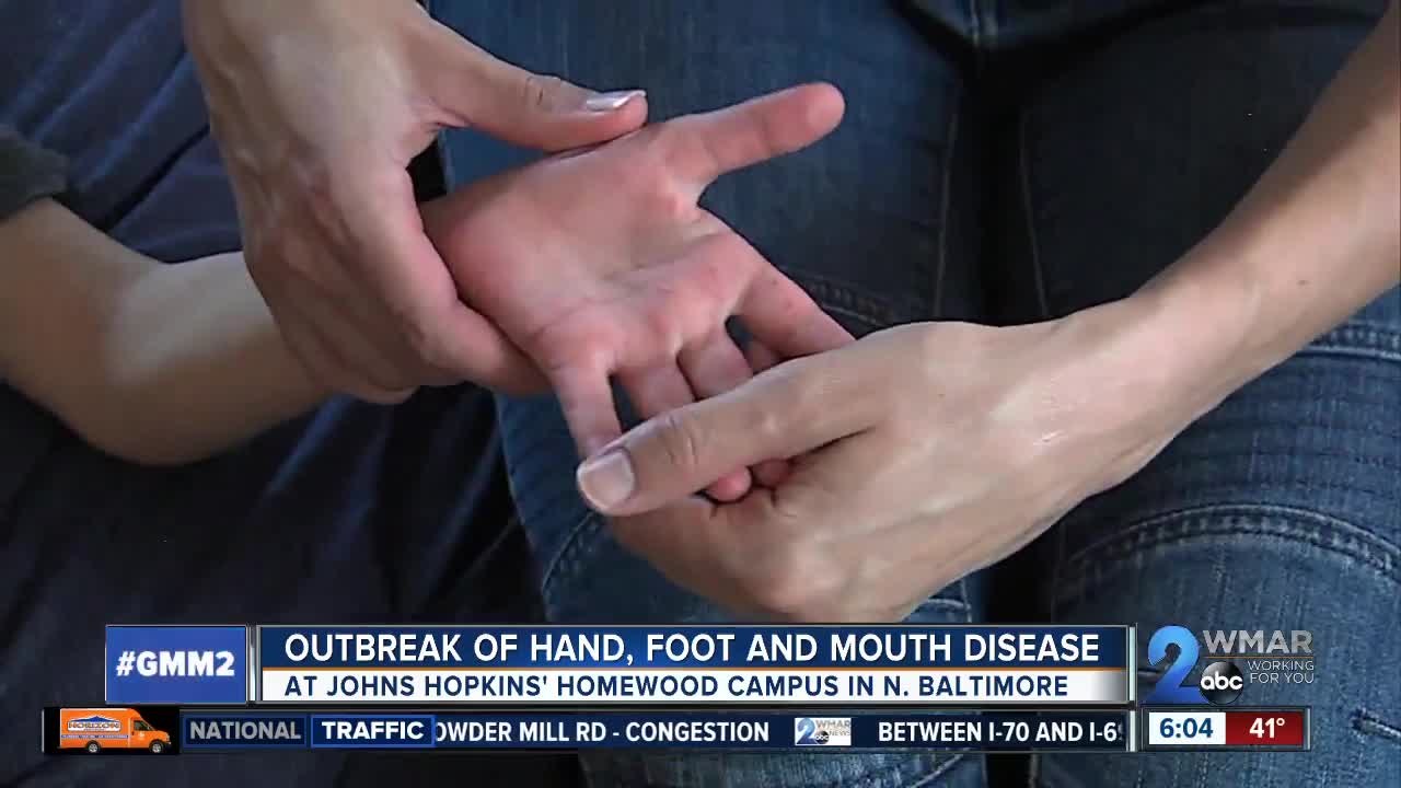 Outbreak of hand, foot, and mouth disease at Johns Hopkins University