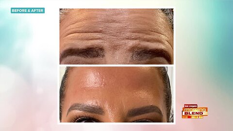 What You Need To Know About Botox