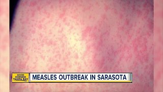 4 cases of Measles reported in Sarasota County