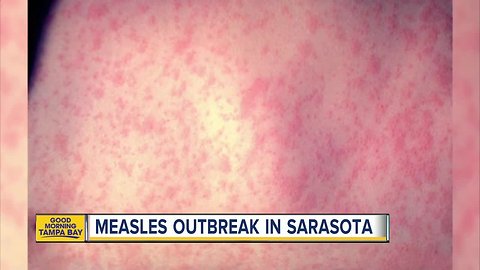 4 cases of Measles reported in Sarasota County