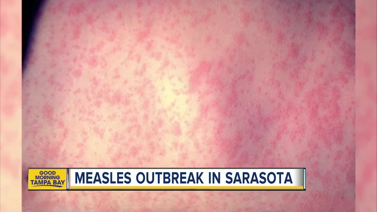 4 cases of Measles reported in Sarasota County