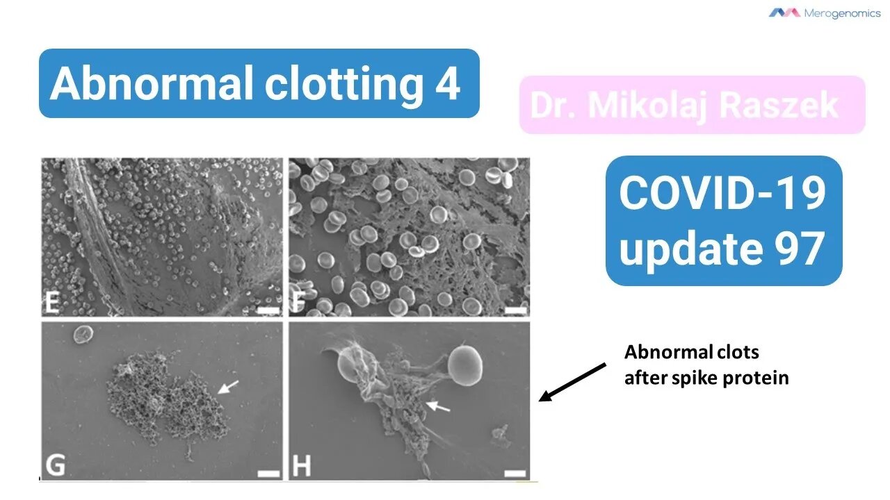 Spike protein inducing clots 1 (abnormal clots episode 4 - update 97)