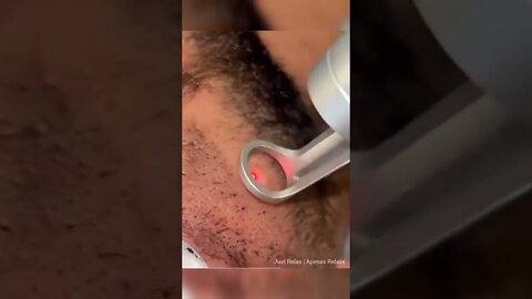 Peeling com Carbono e Laser - Just Relax | Apenas Relaxe