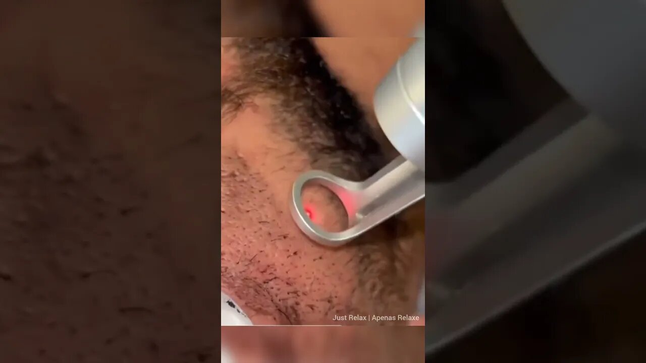 Peeling com Carbono e Laser - Just Relax | Apenas Relaxe