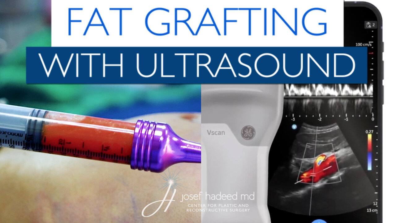 Fat Grafting with Ultrasound