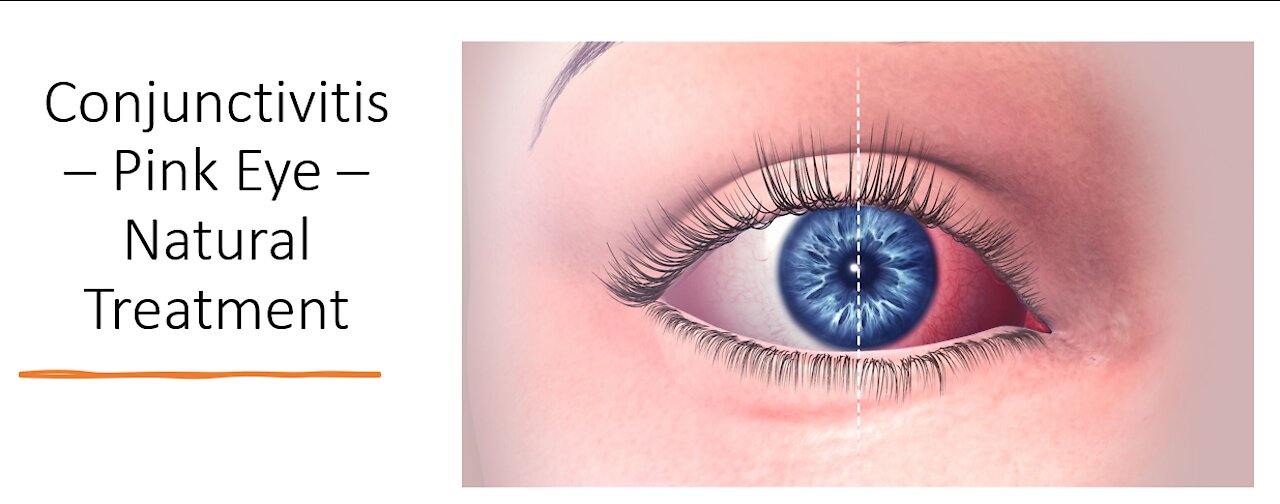 Conjunctivitis - Pink Eye - Treatment