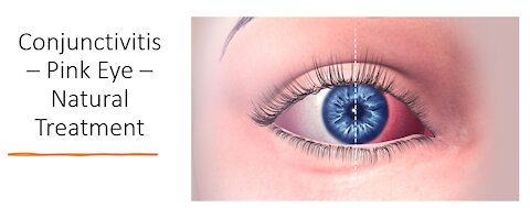 Conjunctivitis - Pink Eye - Treatment