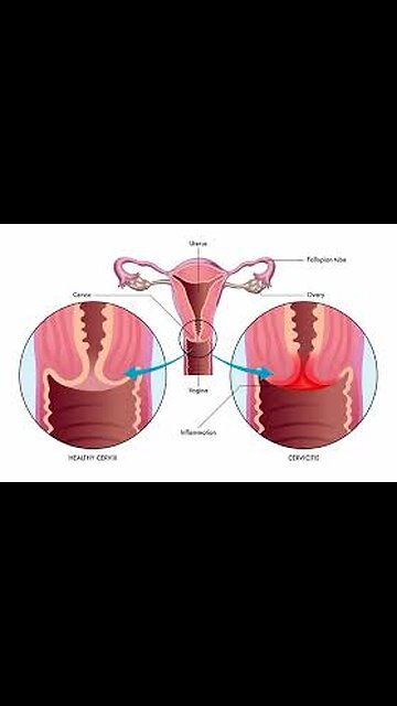 Vaginal Burning After Sex: Heavy Metal Toxins Connection #VaginalHealth #heavymetalpoisoning #covidshots