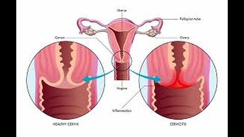 Vaginal Burning After Sex: Heavy Metal Toxins Connection #VaginalHealth #heavymetalpoisoning #covidshots