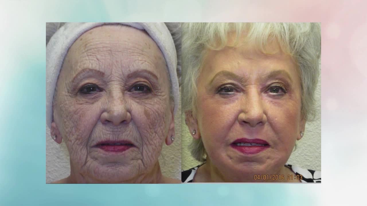 WOW! Look years younger with ONE treatment from Advanced Image Med Spa