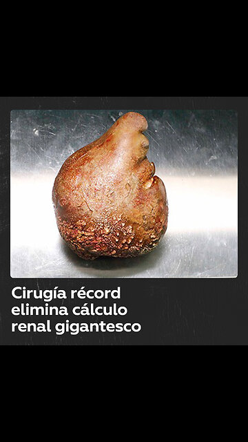 Así es el cálculo renal más grande del mundo extraído de una persona