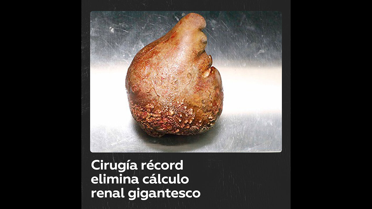 Así es el cálculo renal más grande del mundo extraído de una persona