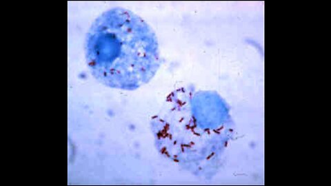 Microparasites from Insect Bites Cause Fevers & Pain-Not "Bacteria"