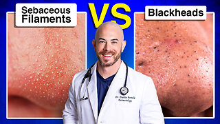 Do You Have Sebaceous Filaments or Blackheads?