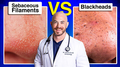 Do You Have Sebaceous Filaments or Blackheads?